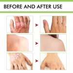 Psoriasis Cream Supplier - ZB 50g Herbal Anti-fungel Eczema Balm