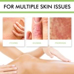 Psoriasis Cream Supplier - ZB 50g Herbal Anti-fungel Eczema Balm