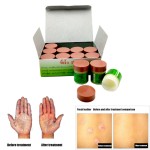 Herbal Ointment Factory - Natural Dermatitis Psoriasis Pruritus Cream