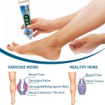 Varicose Vein Cream Factory - 20g Vasculitis Phlebitis Pain Relief