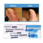 Dermatitis Ointment Factory - Chinese Herbal Extraction Psoriasis Care