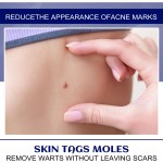 Warts Remover Supplier - 20g ZB Moles Wart Genital Skin Nursing