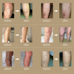 Varicose Vein Patch Manufacturer - Chinese Herb Phlebitis Care Plaster