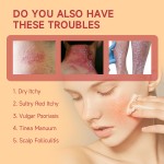 Herbal Ointment Factory - OEM/ODM Psoriasis Cleansing Itchy Skin Relief