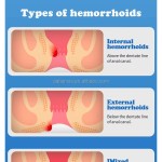 Hemorrhoid Cream Manufacturer - Herbal Massage Crema 20g 0.7oz