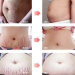 Stretch Mark Set Supplier - Rose Oil Cream Removal OEM