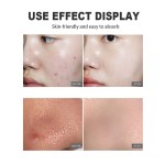 Acne Pads Manufacturer - Alcohol Free Moderate Acne Care