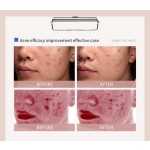 Acne Essence Factory - Pore Shrinking Mouth Closing Solution
