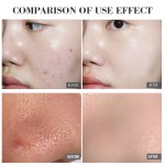 Acne Pads Manufacturer - Alcohol Free Moderate Acne Care