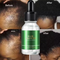 Hair Growth Treatment Manufacturer - Scalp Revitalizing Damage Repair