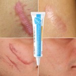 Skin Repair Gel Manufacturer - Medical Grade Scar Removal Cream OEM