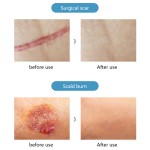 Acne Cream Factory - OEM Adolescent Skin Care Scar Removal