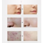 PDRN Mesotherapy Solution - OEM Derma Pen Liquid Manufacturer