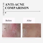 Powder Facial Mask Manufacturer - Best Selling Acne Removal Mask Tool