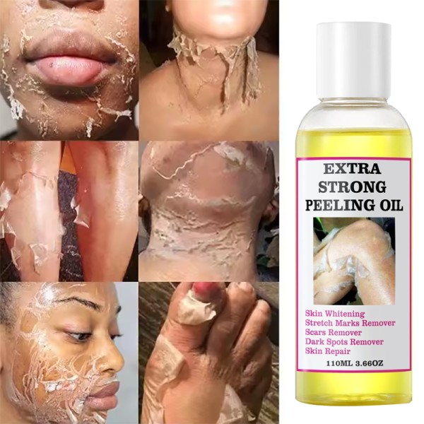 Peeling Oil 110ml - Stretch Mark Exfoliate