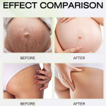 Stretch Mark Cream - Scar Repair Moisturizing