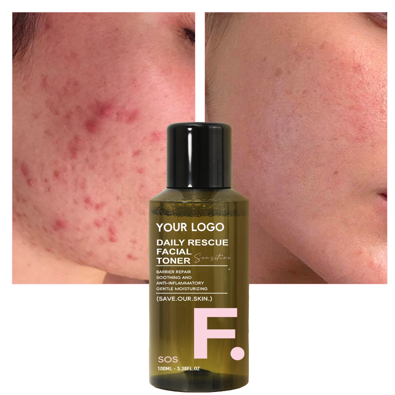 Acne Toner - Hypochlorous Acid Redness Treatment