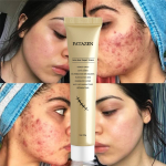 Scar Cream - Acne Mark Redness Reduction