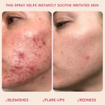 Acne Toner - Hypochlorous Acid Redness Treatment