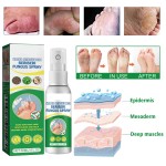 Foot Spray 30ml - Antifungal Herbal Treatment