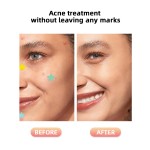 Acne Patch - OEM Hydrocolloid Pimple Treatment Supplier