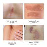 Anti Scar Gel Factory - MULAN Silicone Oil Old Scars Removal Prevention