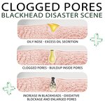 Nose Mask Supplier - OEM Volcanic Mud Blackhead