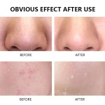 Tea Tree Mousse Factory - Custom Acne Control Antibacterial