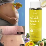 Stretch Marks Oil Supplier - Natural Ingredients Body Peeling