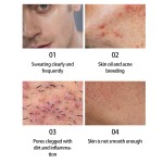 Nose Strips Supplier - High Quality Lanbena Blackhead Removal Deep Cleansing