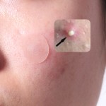 Acne Patch Supplier - Dissolving Waterproof Hydrocolloid Microneedle Hyaluronic