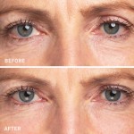 Eye Patches Factory - Reusable Silicone Under Eye Dark Circle Anti Wrinkle