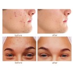 Pimple Patches Manufacturer - Microdart Ultra Thin Invisible All Natural Silver