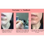 Acne Patch Supplier - Private Label Bulk Wholesale Hydrocolloid Customization