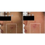 Acne Patches Factory - Fast Healing Acne Removing Customized Pimple Salicylic