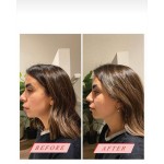 Face Slimming Patch Factory - Korea Double Line Band Chin Lifting V Shape