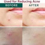 Acne Patches Manufacturer - Invisible Hydrocolloid Spot Healing Round Microneedle