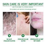 Acne Cream Factory - Anti Acne Follicles Clean