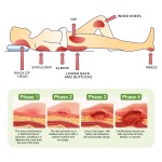 Bedsore Cream Manufacturer - Ultra-Gentle Soothe Care