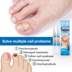 Nail Fungus Liquid Supplier - Painless Anti Bacteria Treatment