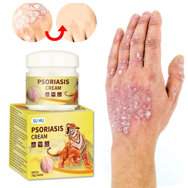 Psoriasis Ointment Manufacturer - 20g Dermatitis Eczema