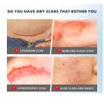 Medical Scar Tape Supplier - Keloid Cesarean Section Care