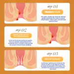 Hemorrhoid Cream Manufacturer - 20g Herbal Anal Fistula