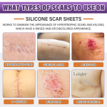 Gel Scar Dressing Supplier - Wound Repair Hypoallergenic