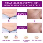 Silicone Scar Sheets Factory - Facial Belly Leg Removal