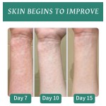 Eczema Cream Supplier - Chinese Herbal Skin Itching