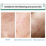 Hydrocolloid Acne Patch Supplier - Various Colors Sizes Star