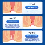 Hemorrhoids Ointment Supplier - Natural Anal Fissure Relief