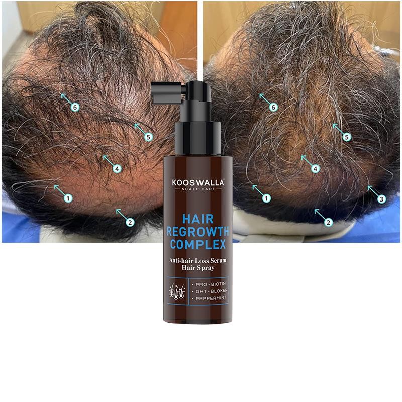 Hot Selling Hair Growth Treatment Anti Hair Loss Spray for Thinning Hair