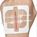 Emergency Wound Device Manufacturer - Zip Sutures Quick Clot